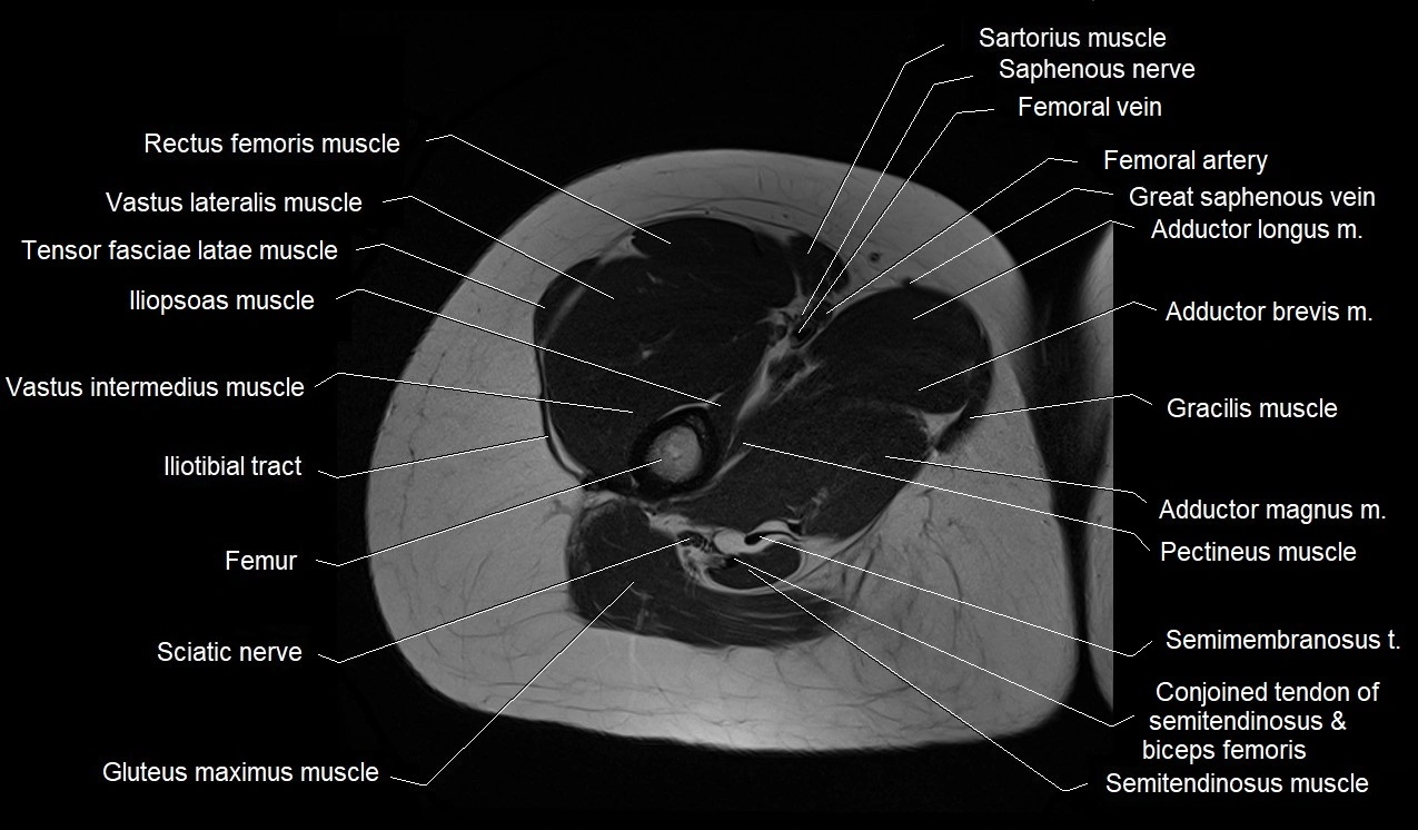 MRI thigh cross sectional anatomy image 17.webp